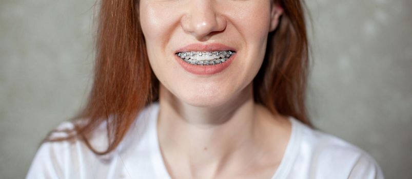 The smile of a young girl with braces on her white teeth. Teeth straightening. Malocclusion. Dental care. 