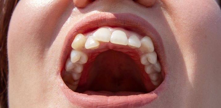 Curved female teeth, before installing braces. Close - up of teeth before treatment by an orthodontist