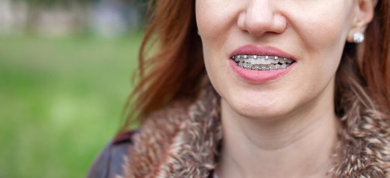 The smile of a young girl with braces on her white teeth. Teeth straightening. Malocclusion. Dental care. 